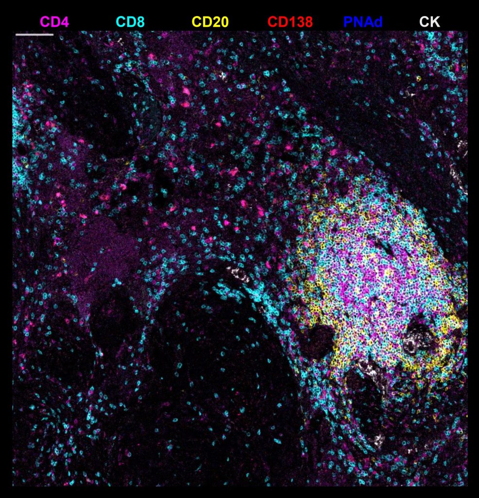 Lymph node like structures may trigger the demise of cancer tumors Pakistan News Today