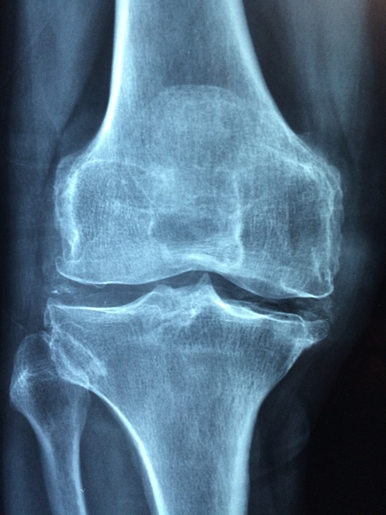 Protein blocking bone development could hold clues for future osteoporosis Pakistan News Today