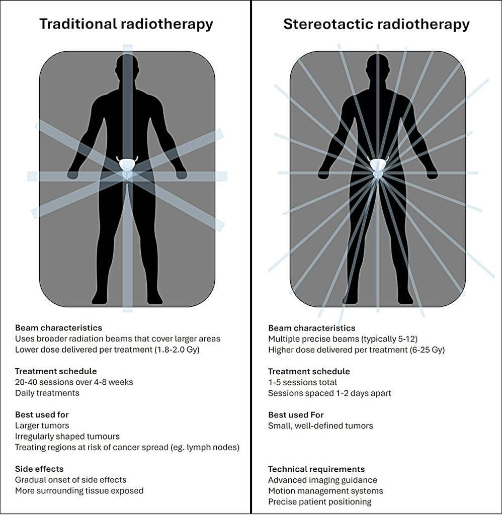 What is stereotactic radiation therapy for prostate cancer How does Pakistan News Today